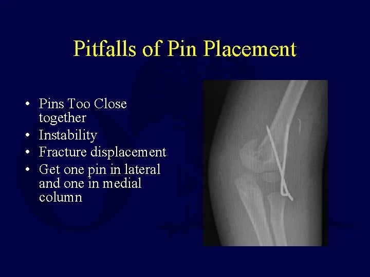 Fractures and Dislocations about the Elbow in the